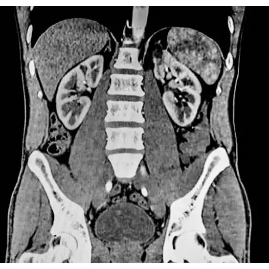 MRI Lower Abdomen Screening